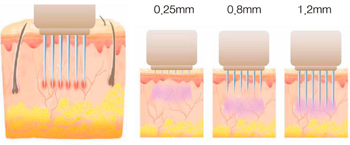 Сколько нужно процедур RF-лифтинга?